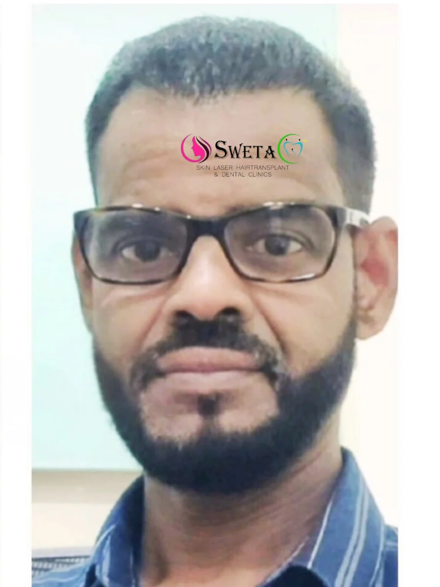 Hair Transplant After