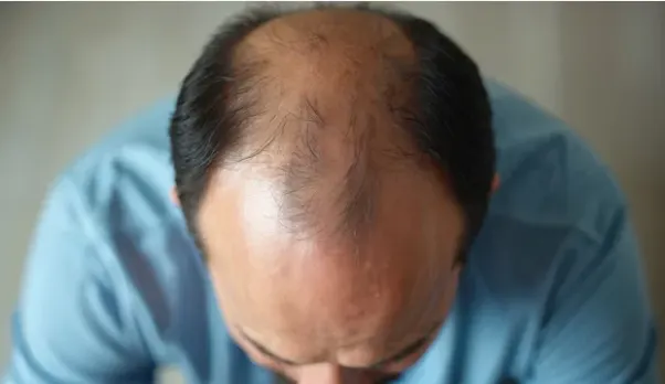 Thinning hair crown view