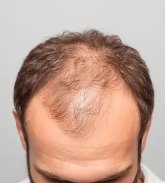 Receding hairline or bald patches